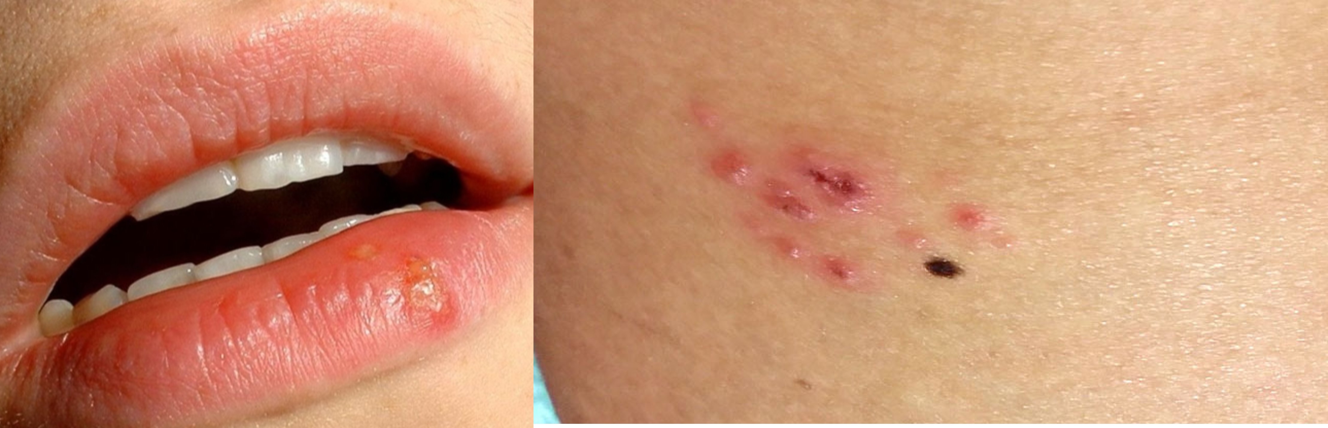 입술포진, 대상포진