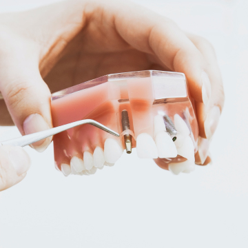 임플란트 지원금