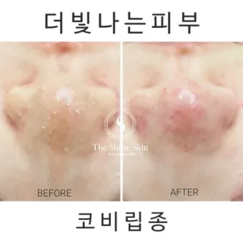 비립종 생기는 이유 비립종 없애는 방법 피부 관리법_14