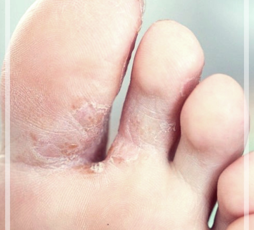 뿌리는무좀약 & 바르는 무좀약 차이점.