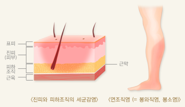 연조직염 침범부위