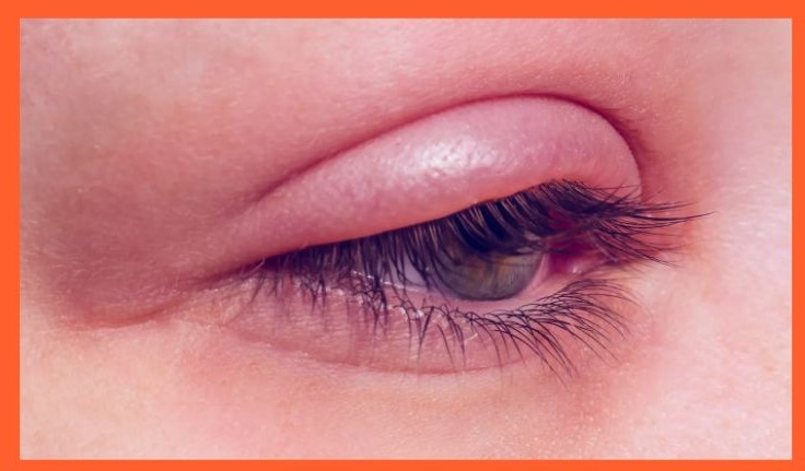 포도막염 증상 원인