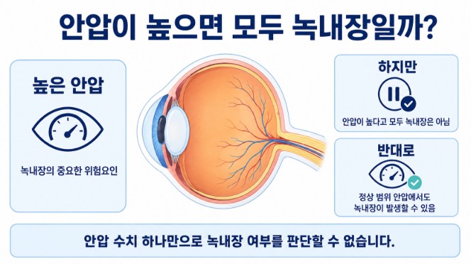 높은 안압은 녹내장의 위험요인이지만 안압 수치만으로 녹내장을 판단할 수 없다는 설명