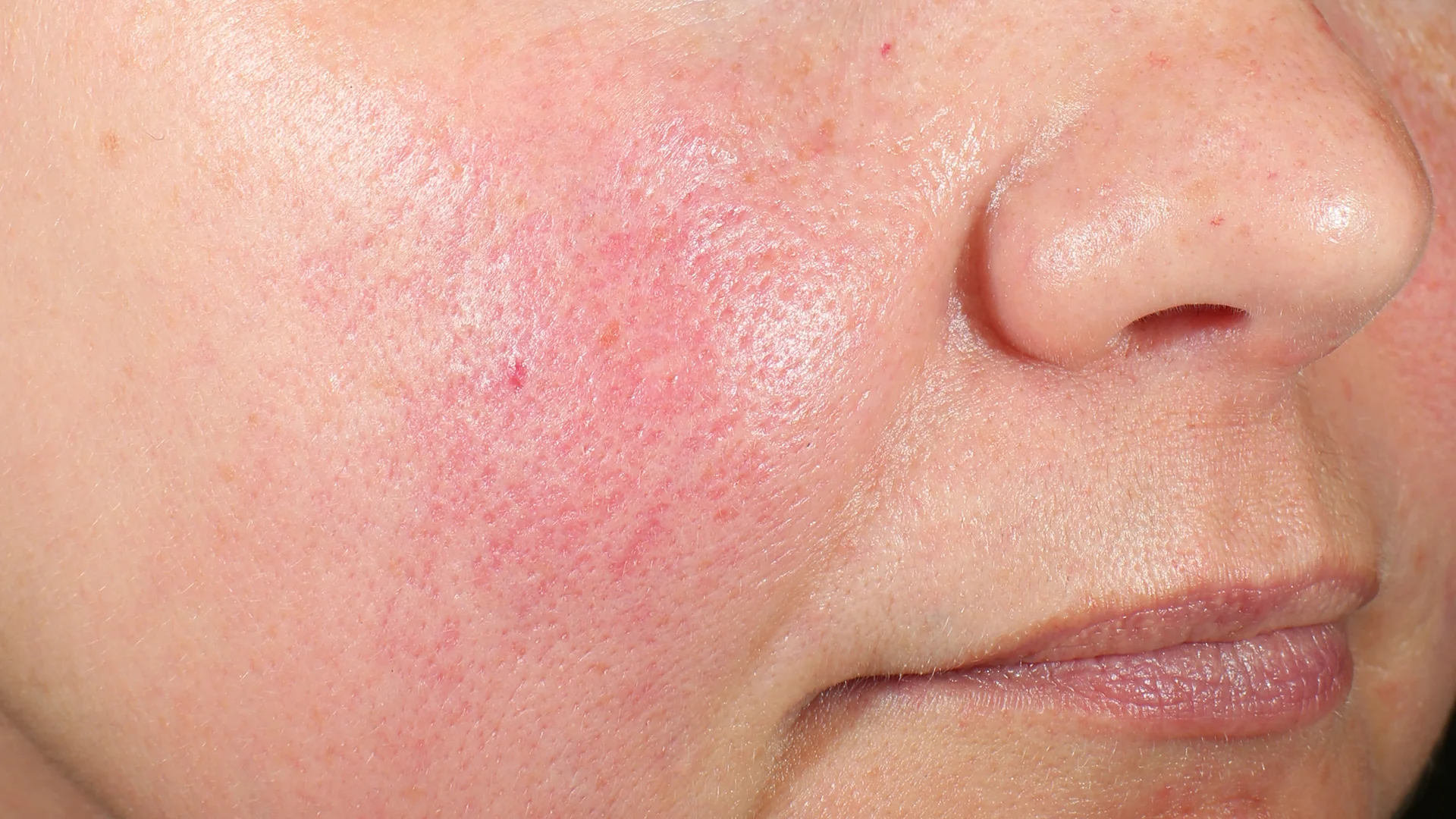 과도한 각질 제거가 피부를 망치는 이유