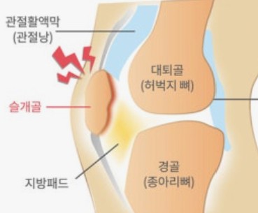 슬개골 통증