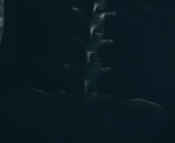 척추관 협착증 운동법과 치료방법