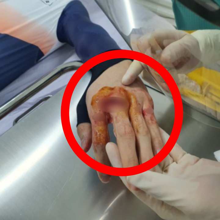 왼손이-찢겨진-쇼트트랙-박장혁선수