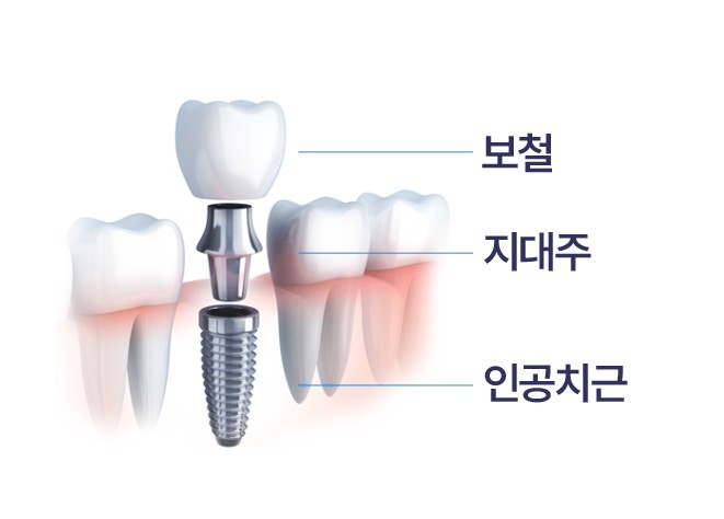 건강보험 임플란트