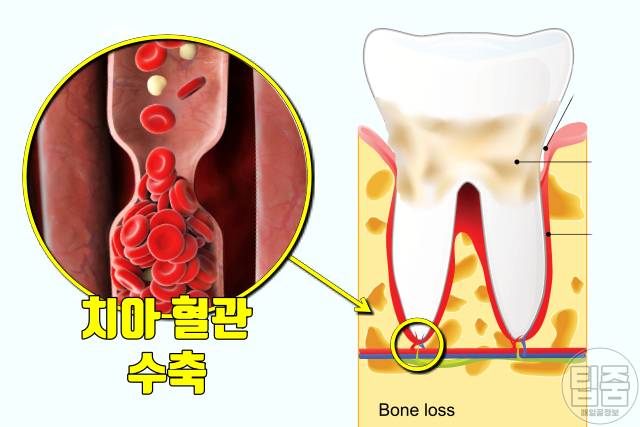 스트레스 받으면 이빨 흔들리는 이유,스트레스 잇몸 부음 이시림 출혈