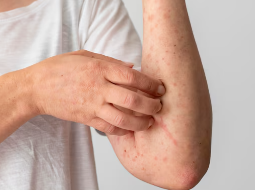 피부 붉은반점 11