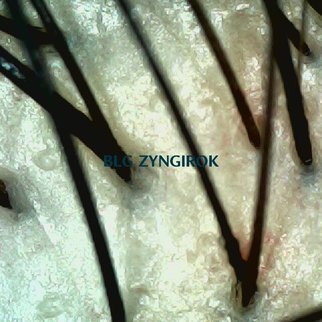 피나모아 복용 25주차 정수리 부분 두피 사진 모습이다.