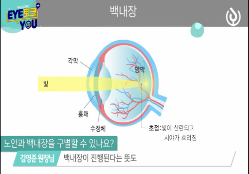 백내장 증상