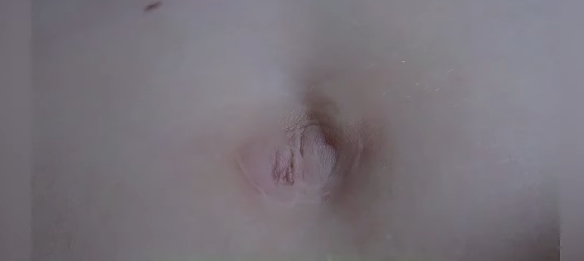 배꼽주위 통증