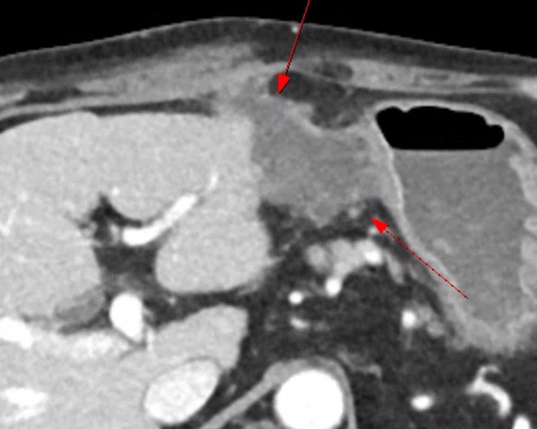 한의원에서 사혈을 뽑는 치료 후 발생한 감염