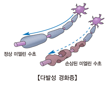 다발성 경화증 정보 관련 이미지