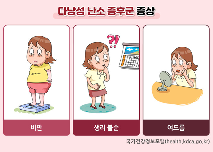 다낭성 난소 증후군 증상 이미지