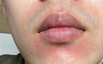 스트레스가 미치는 피부의 변화: 아드레날린과 염증 반응