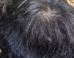 정수리 두피 모습