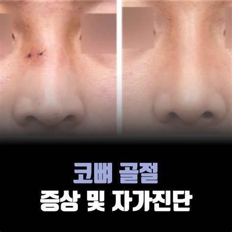 뼈골절 수술비용