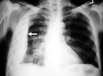 폐에 물이 차는 원인 증상 물참 관리 포인트에 대한 건강정보_10