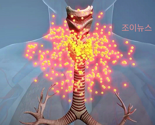 갑상선 기능 항진증_출처:EBS 다큐 유튜브