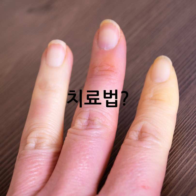 수족냉증과 레이노증후군 차이