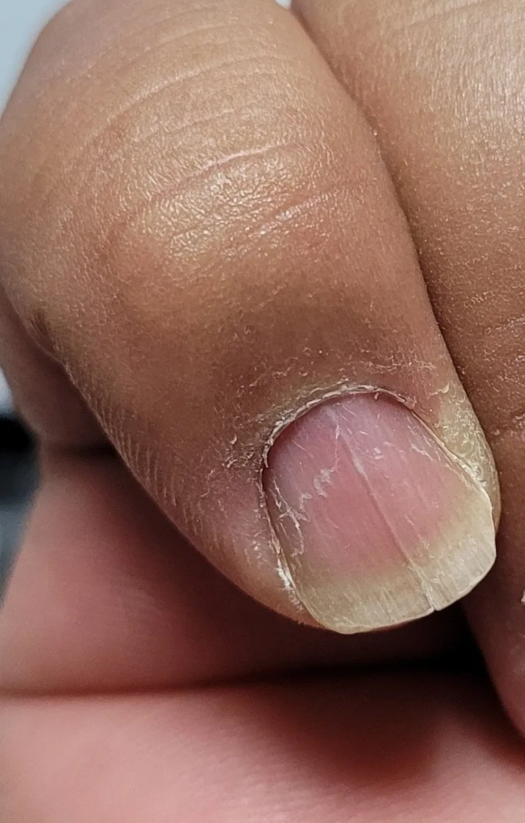 손톱이 갈라지는 이유 원인 증상 대처법_5