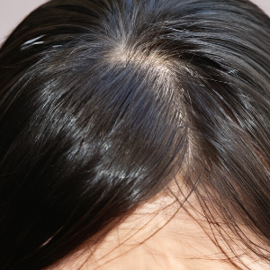 5. 자연치유의 중요성: 건강한 생활습관과 원형탈모