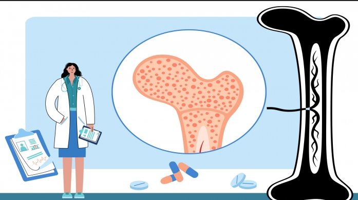 골다공증골밀도검사수치보는법