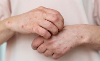 여름철 햇빛 알러지, 예방과 관리 방법 총정리!