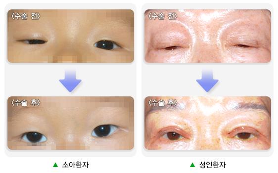 안검하수_수술전후