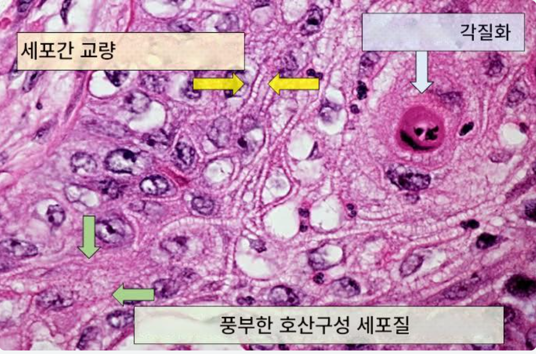 편평세포암