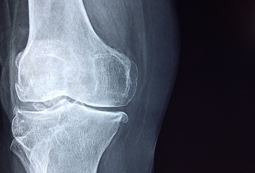 관절염 초기증상 골관절염 류마티스