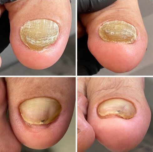 발톱무좀 증상