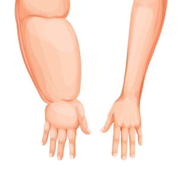 유방암 겨드랑이 림프부종 팔 증상 원인 치료 수술 후