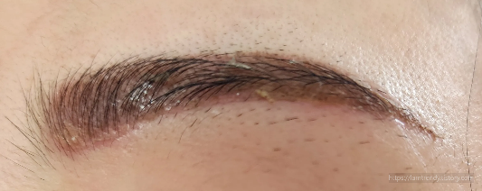 눈썹문신 치료후 염증 및 딱지