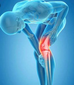 골다공증 뼈 약화