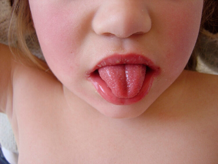 성홍열 관련 사진