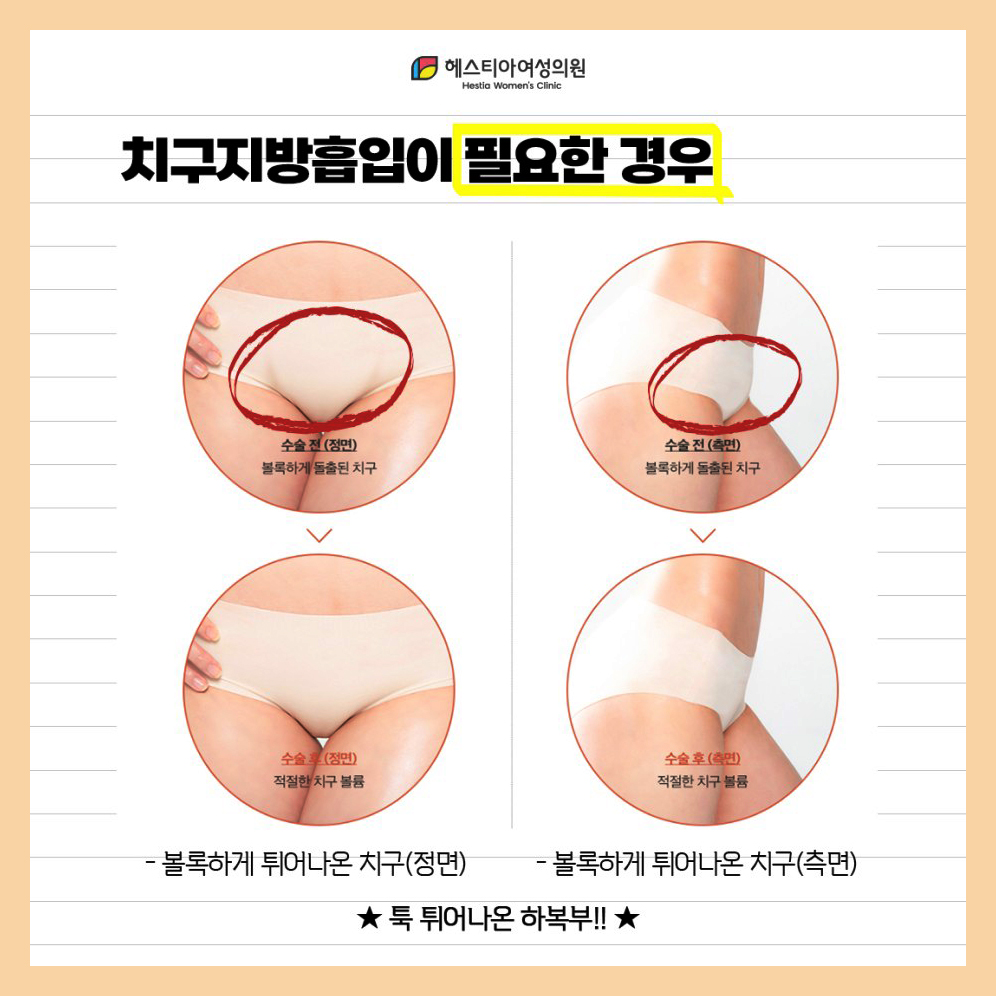 치구지방흡입이 필요한 경우