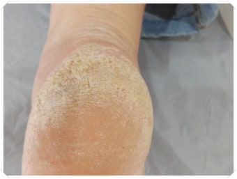 발 각질 간단하게 제거하는법