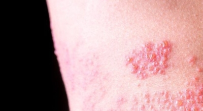 대상포진이미지