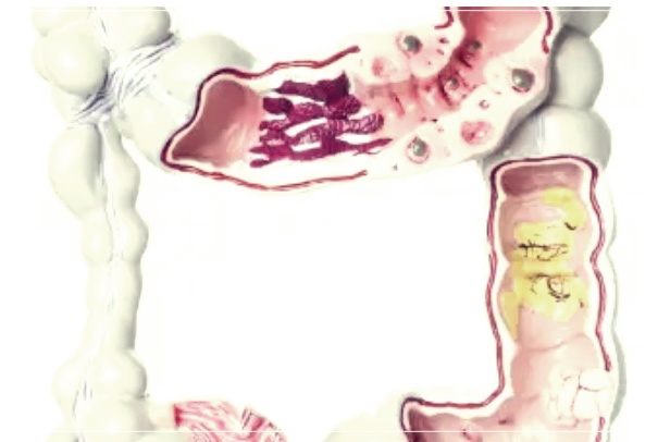 장 마비 증상, 원인 및 해결책.