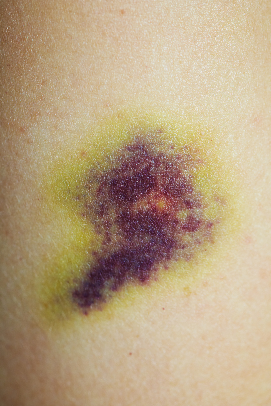 시술로 인한 멍, 빨리 없애는 실질적인 방법 총정리