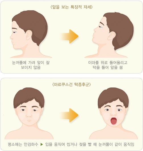 안검하수