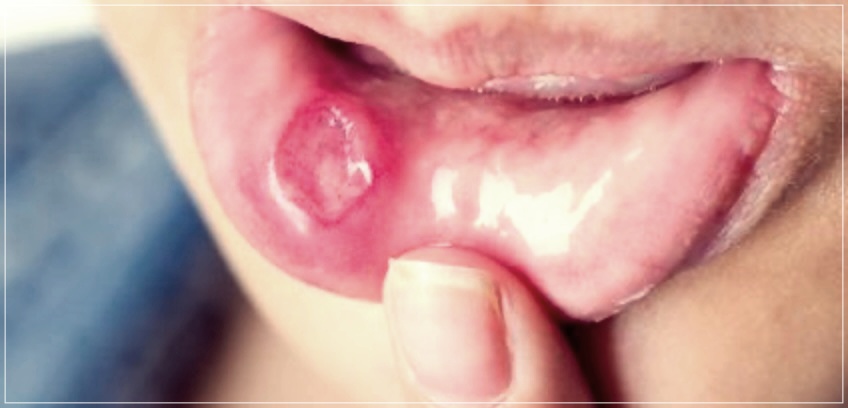 구내염 패치: 가격, 장단점, 사용방법