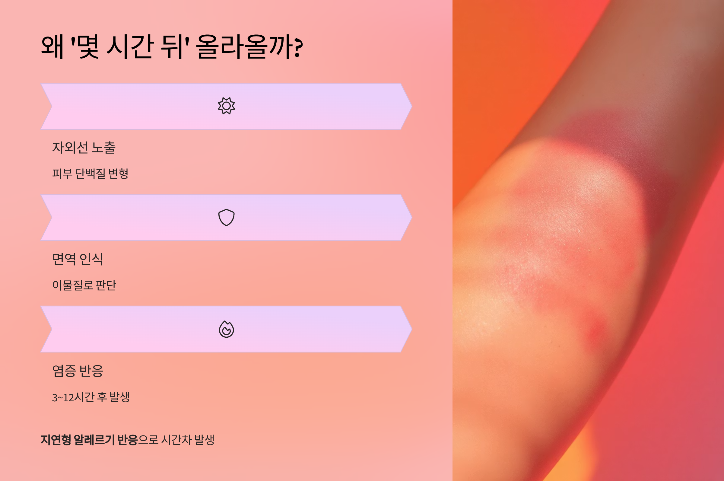 햇빛알레르기 왜 몇시간 뒤에 올라올까?