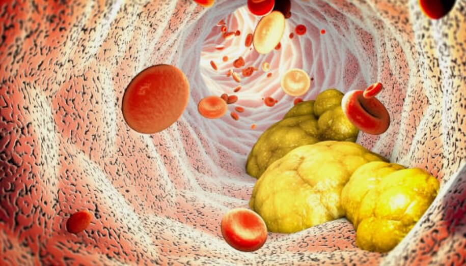 콜레스테롤수치유전