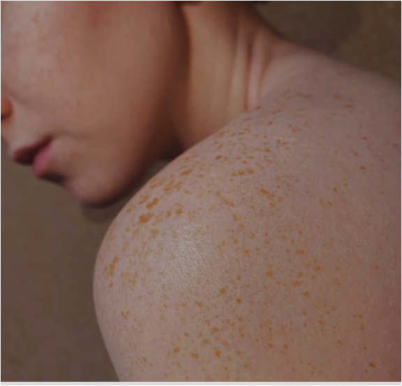 여러-반점이-있는-여성의-어깨