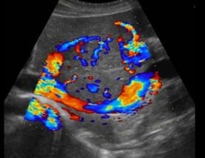 FNH (Focal Nodular hyperplasia)
