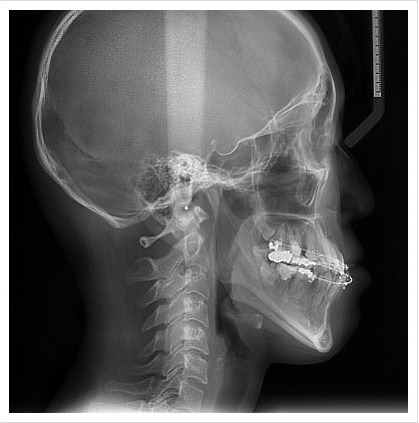 양악수술전(옆면)